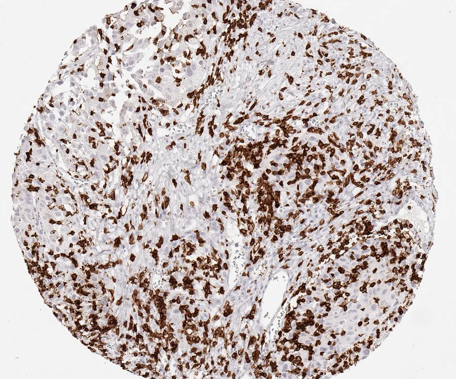 Immunohistochemistry of human CD8 with anti-CD8 clone TC8 (DIA-TC8) in FFPE tissue – dense infiltrate of CD8-positive lymphocytes in muscle-invasive urothelial carcinoma of the urinary bladder; figure 25 of the previous ONCOdianova CD8 gallery.