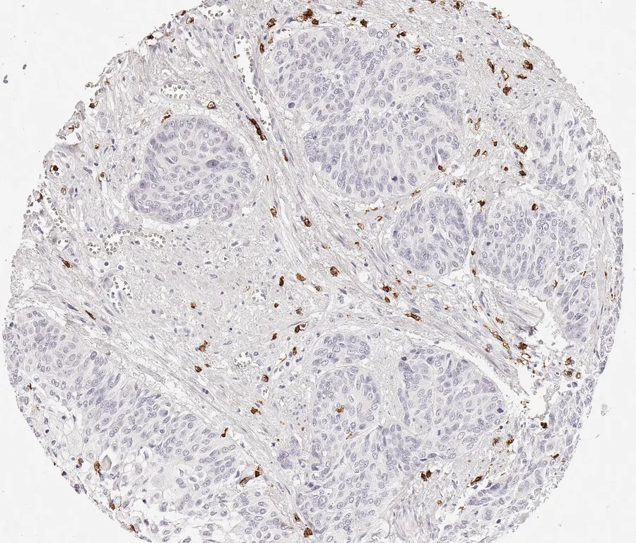Immunohistochemistry of human CD8 with anti-CD8 clone TC8 (DIA-TC8) in FFPE tissue – CD8-positive lymphocytes in vaginal squamous cell carcinoma; figure 17 of the previous ONCOdianova CD8 gallery (tissue designation from the source file name).