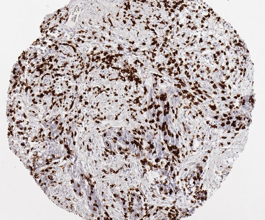 Immunohistochemistry of human CD8 with anti-CD8 clone TC8 (DIA-TC8) in FFPE tissue – very dense infiltration by CD8-positive lymphocytes in vaginal squamous cell carcinoma; figure 18 of the previous ONCOdianova CD8 gallery.