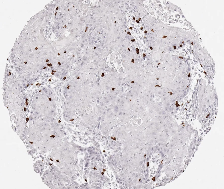 Immunohistochemistry of human CD8 with anti-CD8 clone TC8 (DIA-TC8) in FFPE tissue – scattered CD8-positive lymphocytes, predominantly located at the stroma–epithelium interface in squamous cell carcinoma of the vulva; figure 13 of the previous ONCOdianova CD8 gallery.