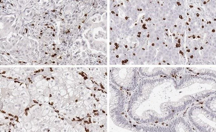 Immunohistochemistry of human CD8 with anti-CD8 clone TC8 (DIA-TC8) in routine FFPE tissue – figures A–D of the datasheet: A adenocarcinoma of the lung with marked infiltration by CD8-positive lymphocytes; B dense infiltrate of CD8-positive lymphocytes in a serous carcinoma of the ovary; C clear cell kidney cancer with a high number of CD8-positive lymphocytes; D CD8-positive lymphocytes in a low-grade tubular adenoma of the colon.