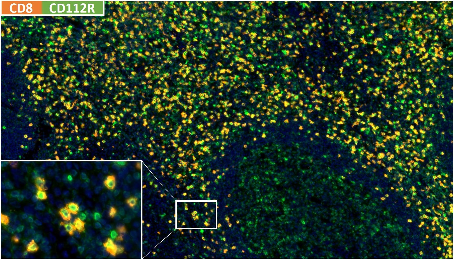 Fluorescence multiplex immunohistochemistry of a normal human tonsil with anti-CD8 (DIA-TC8; orange/red) and anti-CD112R/PVRIG clone R12 (DIA-R12; green), nuclei blue – overlay with detail inset